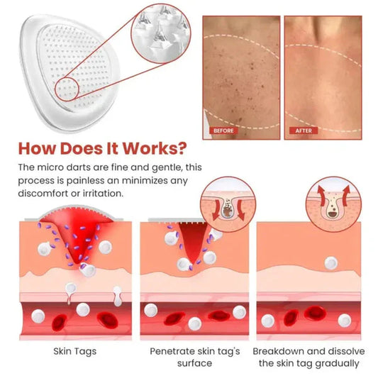 Afraz DermaSmooth Skin Tag Remover Patches – Fast, Safe & Painless Tag and Mole Removal