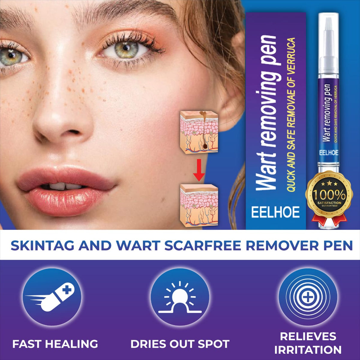 Afraz Smart Wart Remover Gel Pen – Powerful Fast-Acting Skin Treatment